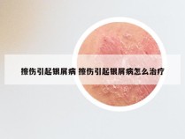 擦伤引起银屑病 擦伤引起银屑病怎么治疗