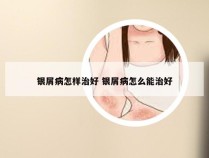 银屑病怎样治好 银屑病怎么能治好