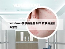 windows皮肤癣是什么样 皮肤藓是什么意思