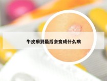 牛皮癣到最后会变成什么病