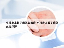 小孩身上长了癣怎么治疗 小孩身上长了癣怎么治疗好