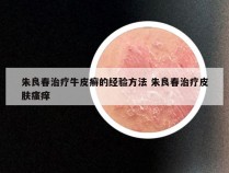 朱良春治疗牛皮癣的经验方法 朱良春治疗皮肤瘙痒