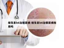 维生素b6治银屑病 维生素b6治银屑病有用吗