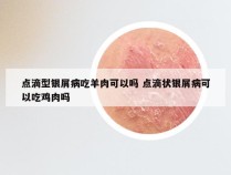 点滴型银屑病吃羊肉可以吗 点滴状银屑病可以吃鸡肉吗