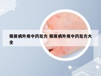 银屑病外用中药处方 银屑病外用中药处方大全