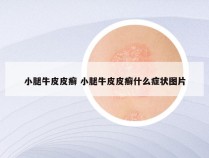 小腿牛皮皮癣 小腿牛皮皮癣什么症状图片