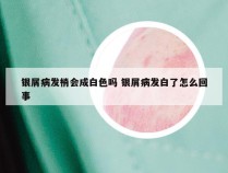 银屑病发梢会成白色吗 银屑病发白了怎么回事