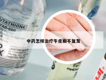 中药怎样治疗牛皮癣不复发