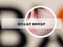 癣怎么冶疗 癣如何治疗