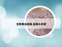 怎样根治皮癣 皮癣小妙招