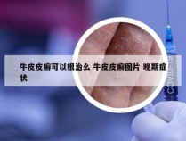 牛皮皮癣可以根治么 牛皮皮癣图片 晚期症状