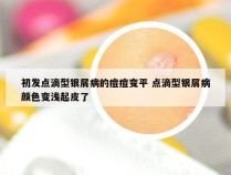 初发点滴型银屑病的痘痘变平 点滴型银屑病颜色变浅起皮了