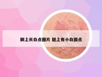 脚上长白点图片 腿上有小白圆点