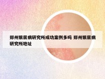 郑州银屑病研究所成功案例多吗 郑州银屑病研究所地址