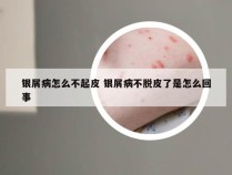 银屑病怎么不起皮 银屑病不脱皮了是怎么回事