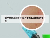 癣严重怎么治疗好 癣严重怎么治疗好的快一点