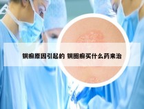 铜癣原因引起的 铜圈癣买什么药来治