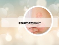 牛皮癣患者怎样治疗