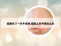 屁股长了一片牛皮癣 屁股上长牛癣怎么办