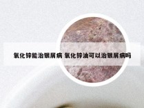 氧化锌能治银屑病 氧化锌油可以治银屑病吗