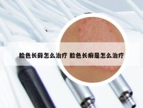 脸色长藓怎么治疗 脸色长癣是怎么治疗