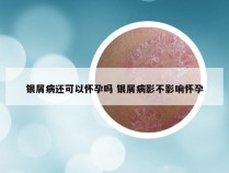 银屑病还可以怀孕吗 银屑病影不影响怀孕