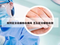 如何区分白癣和白癜风 怎么区分癣和白斑