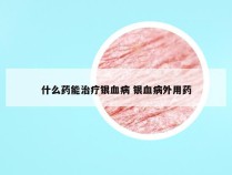 什么药能治疗银血病 银血病外用药