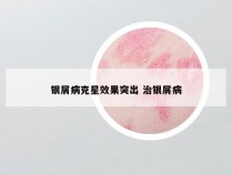 银屑病克星效果突出 治银屑病