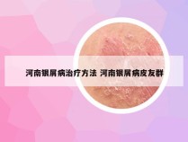 河南银屑病治疗方法 河南银屑病皮友群