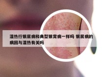 湿热行银屑病和典型银霄病一样吗 银屑病的病因与湿热有关吗