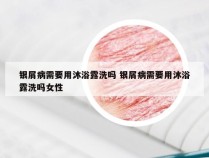 银屑病需要用沐浴露洗吗 银屑病需要用沐浴露洗吗女性