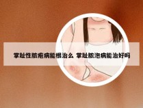 掌趾性脓疱病能根治么 掌趾脓泡病能治好吗