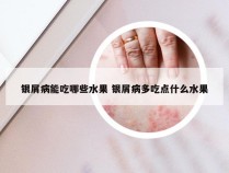 银屑病能吃哪些水果 银屑病多吃点什么水果