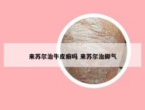 来苏尔治牛皮癣吗 来苏尔治脚气