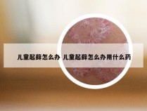 儿童起藓怎么办 儿童起藓怎么办用什么药