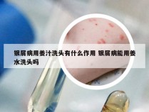 银屑病用姜汁洗头有什么作用 银屑病能用姜水洗头吗