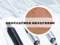 顽癣净可以治疗哪些病 顽癣净治疗银屑病吗