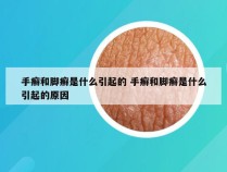 手癣和脚癣是什么引起的 手癣和脚癣是什么引起的原因