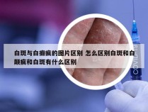 白斑与白癫疯的图片区别 怎么区别白斑和白颠疯和白斑有什么区别