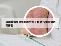 洛阳看银屑病哪家医院好不好 洛阳银屑病医院排名