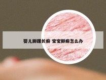 婴儿脚踝长癣 宝宝脚癣怎么办