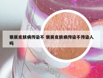 银屑皮肤病传染不 银屑皮肤病传染不传染人吗