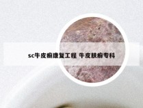 sc牛皮癣康复工程 牛皮肤癣专科