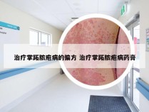 治疗掌跖脓庖病的偏方 治疗掌跖脓疱病药膏