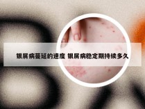 银屑病蔓延的速度 银屑病稳定期持续多久