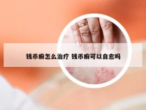 钱币癣怎么治疗 钱币癣可以自愈吗