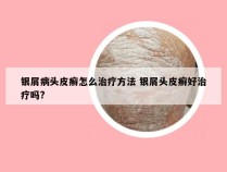 银屑病头皮癣怎么治疗方法 银屑头皮癣好治疗吗?