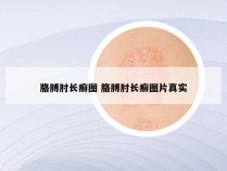 胳膊肘长癣图 胳膊肘长癣图片真实