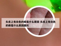 头皮上有白色的癣是什么原因 头皮上有白色的癣是什么原因图片